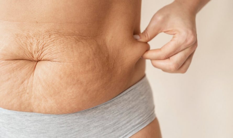 Jak pozbyć się cellulitu z brzucha – poznaj skuteczne sposoby na cellulit na brzuchu